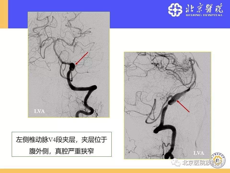 【PPT】HRMRI在缺血性脑卒中精准病因诊断中的应用-69