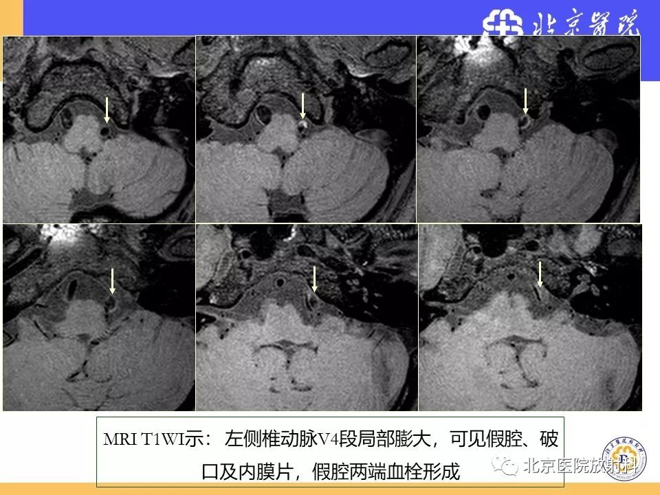 【PPT】HRMRI在缺血性脑卒中精准病因诊断中的应用-68