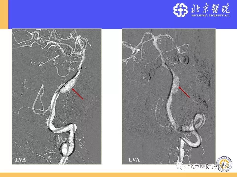 【PPT】HRMRI在缺血性脑卒中精准病因诊断中的应用-70
