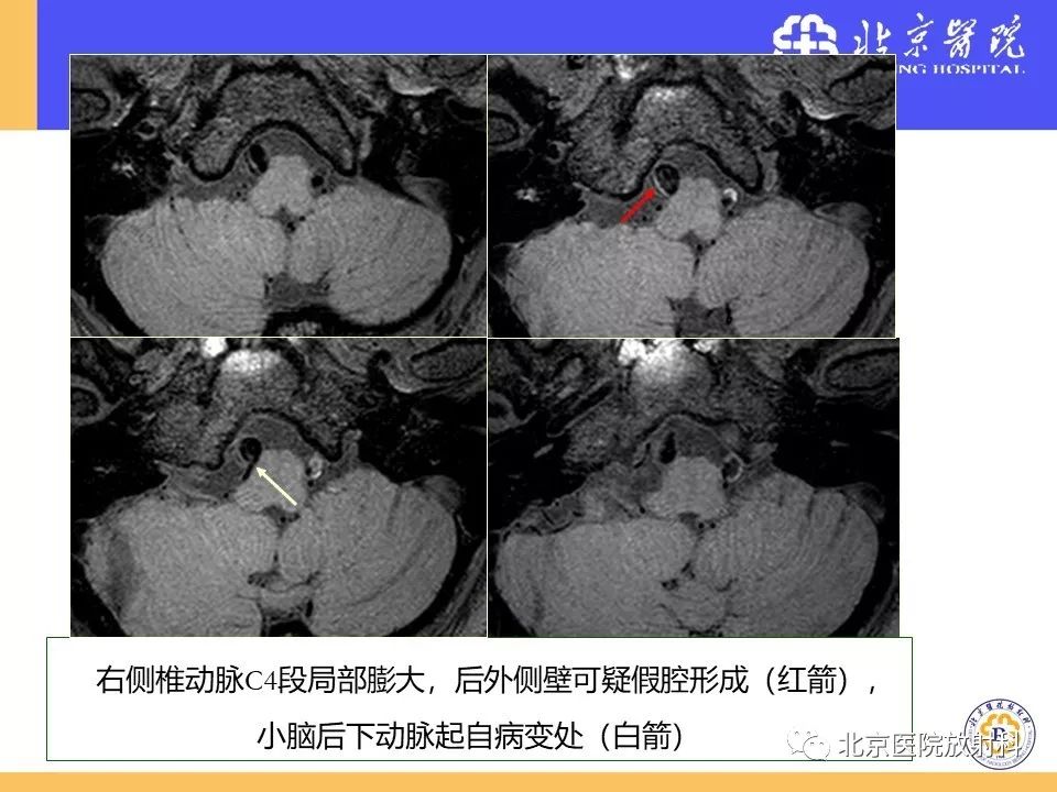 【PPT】HRMRI在缺血性脑卒中精准病因诊断中的应用-71
