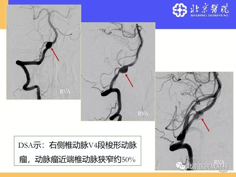 【PPT】HRMRI在缺血性脑卒中精准病因诊断中的应用-72