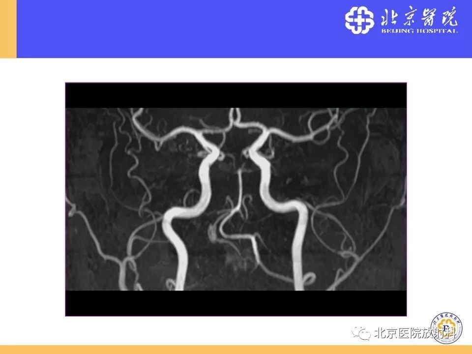 【PPT】HRMRI在缺血性脑卒中精准病因诊断中的应用-74
