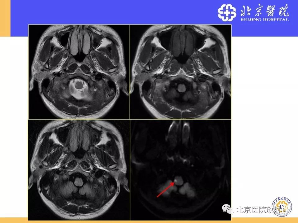 【PPT】HRMRI在缺血性脑卒中精准病因诊断中的应用-73