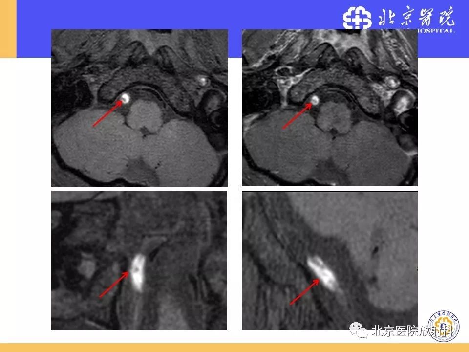 【PPT】HRMRI在缺血性脑卒中精准病因诊断中的应用-75