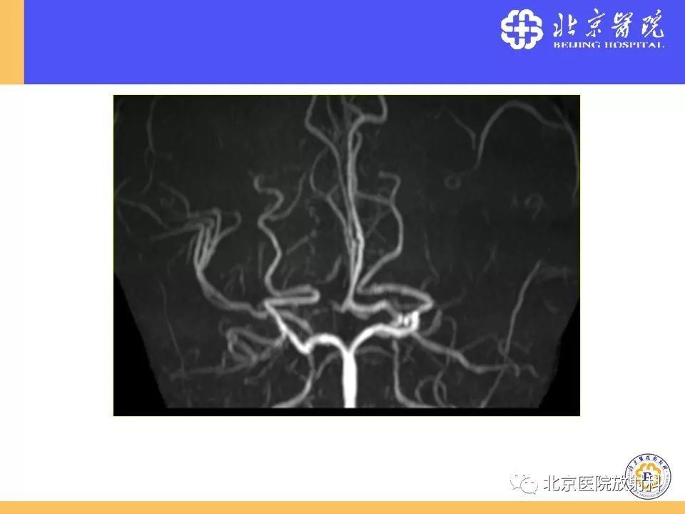 【PPT】HRMRI在缺血性脑卒中精准病因诊断中的应用-76