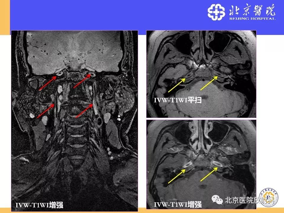 【PPT】HRMRI在缺血性脑卒中精准病因诊断中的应用-77