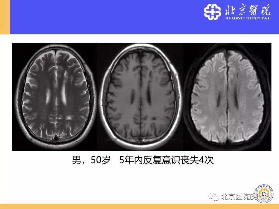 【PPT】HRMRI在缺血性脑卒中精准病因诊断中的应用-80