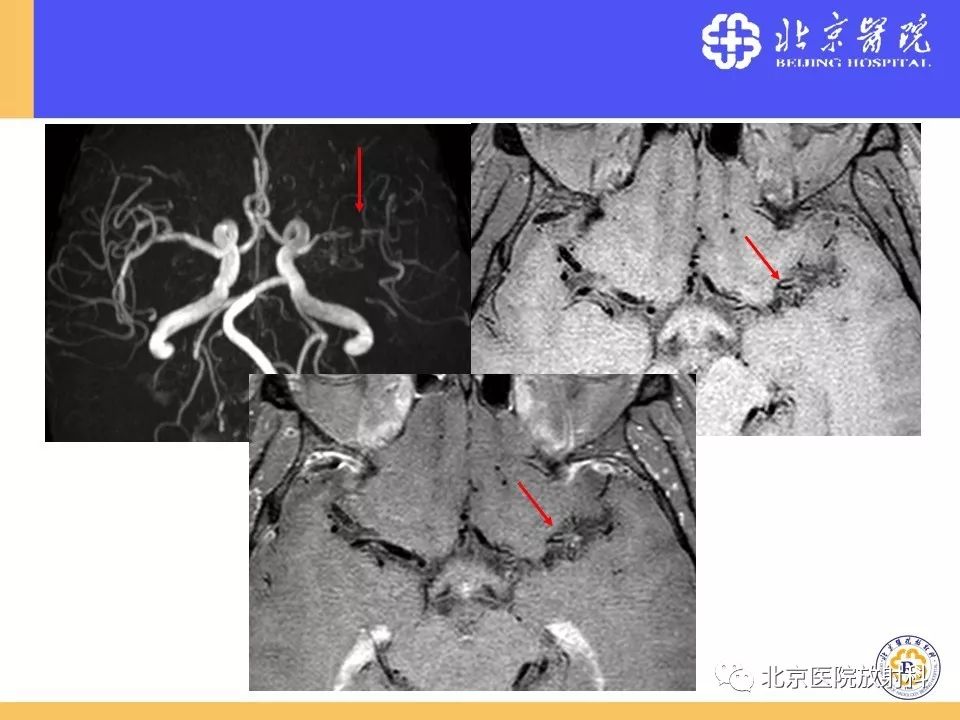 【PPT】HRMRI在缺血性脑卒中精准病因诊断中的应用-81