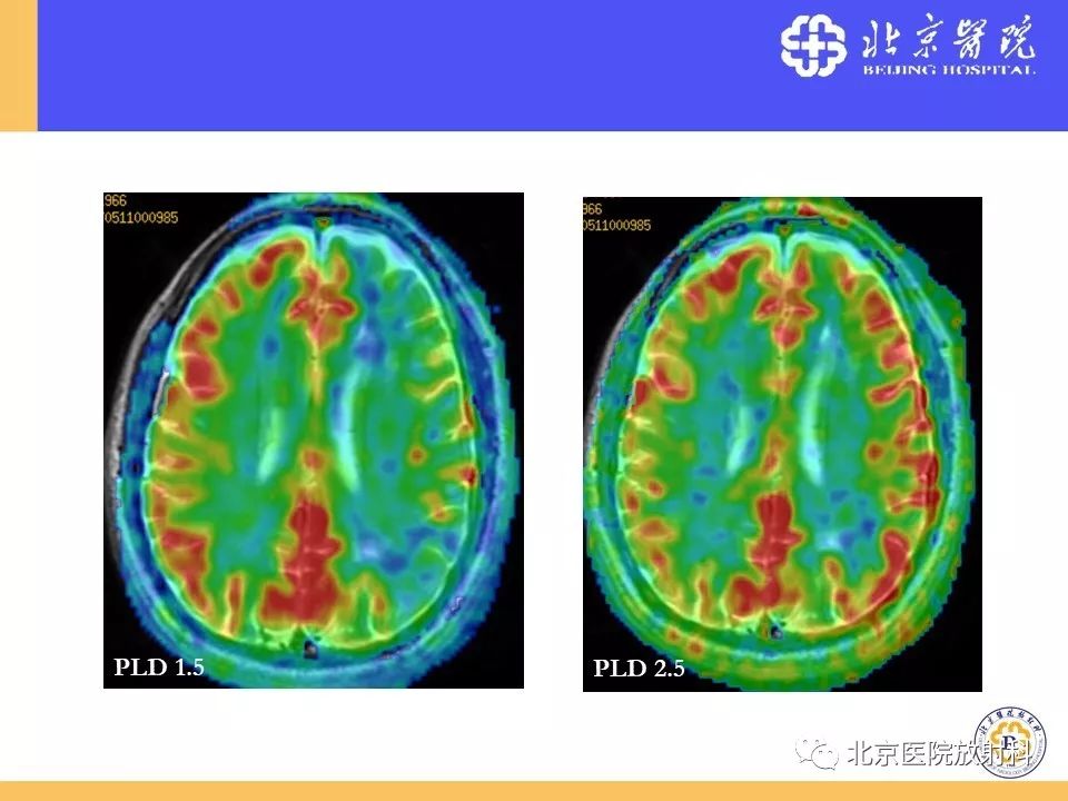 【PPT】HRMRI在缺血性脑卒中精准病因诊断中的应用-82