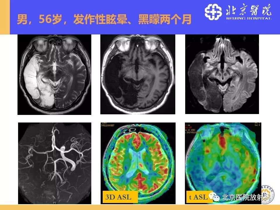 【PPT】HRMRI在缺血性脑卒中精准病因诊断中的应用-83