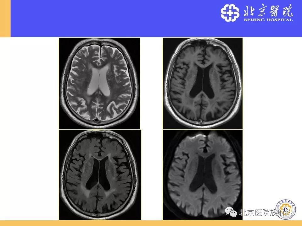 【PPT】HRMRI在缺血性脑卒中精准病因诊断中的应用-84