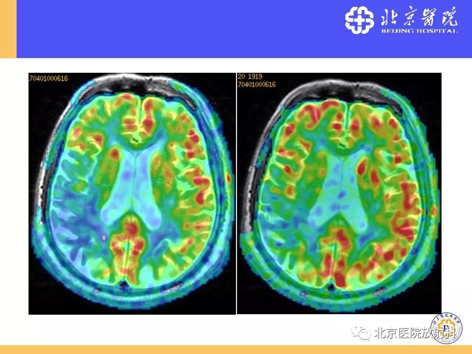 【PPT】HRMRI在缺血性脑卒中精准病因诊断中的应用-85