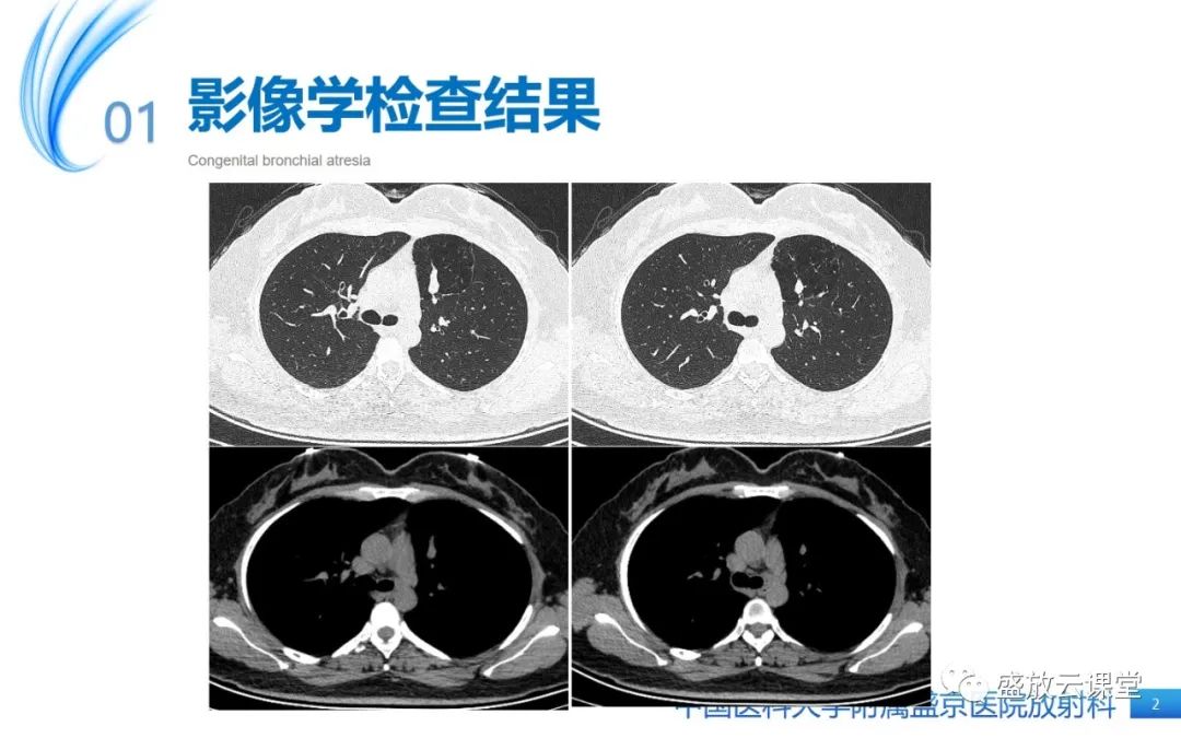 【PPT】先天性支气管闭锁-2