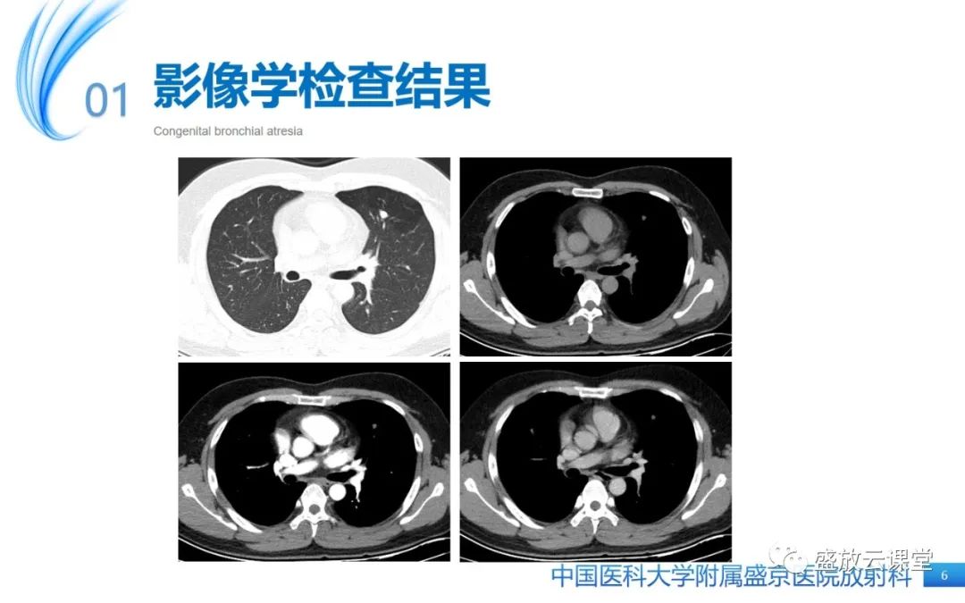 【PPT】先天性支气管闭锁-6