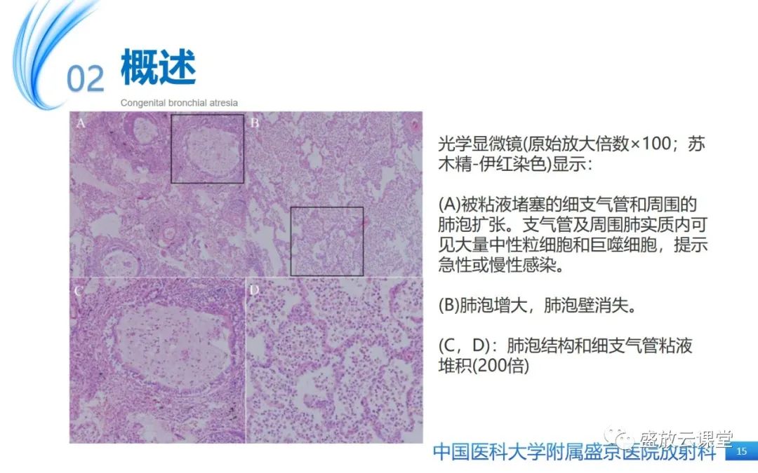 【PPT】先天性支气管闭锁-14