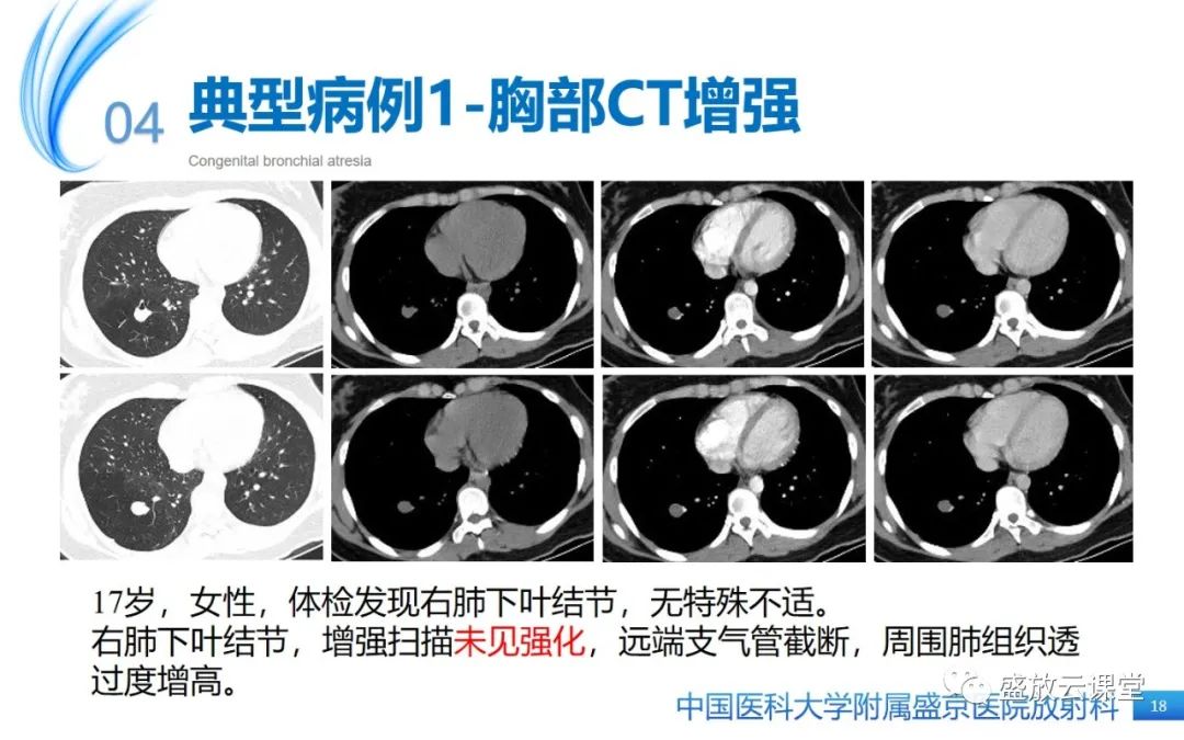 【PPT】先天性支气管闭锁-17