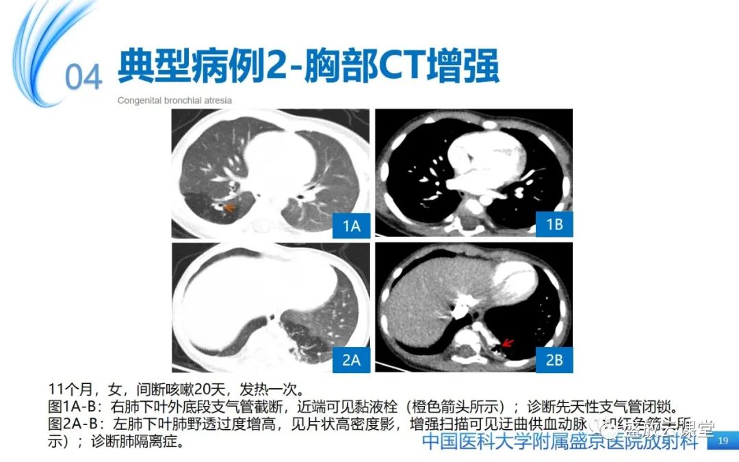 【PPT】先天性支气管闭锁-18