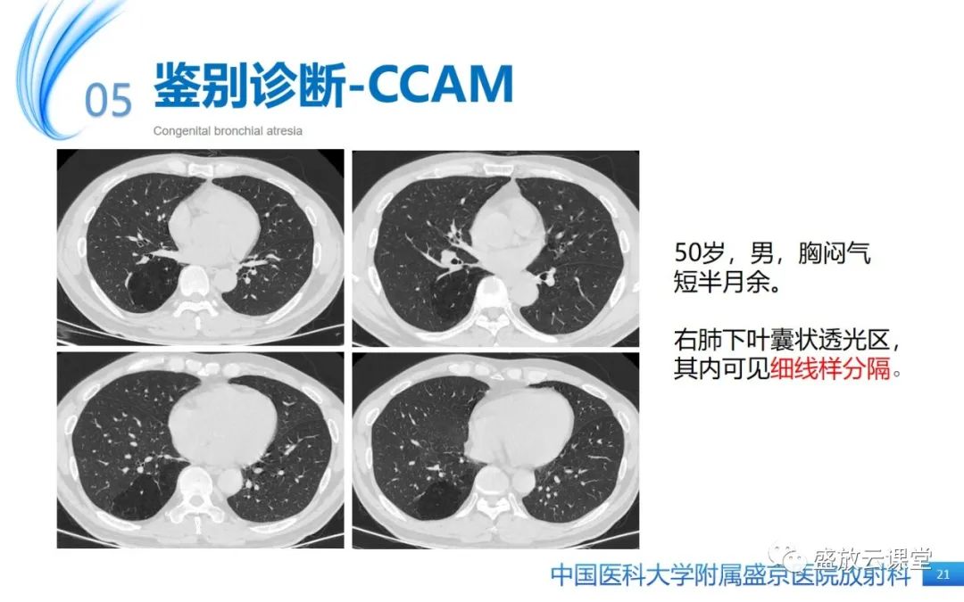 【PPT】先天性支气管闭锁-20