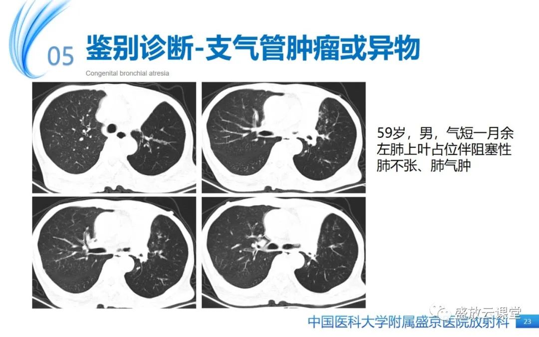 【PPT】先天性支气管闭锁-22