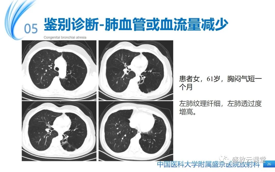 【PPT】先天性支气管闭锁-25