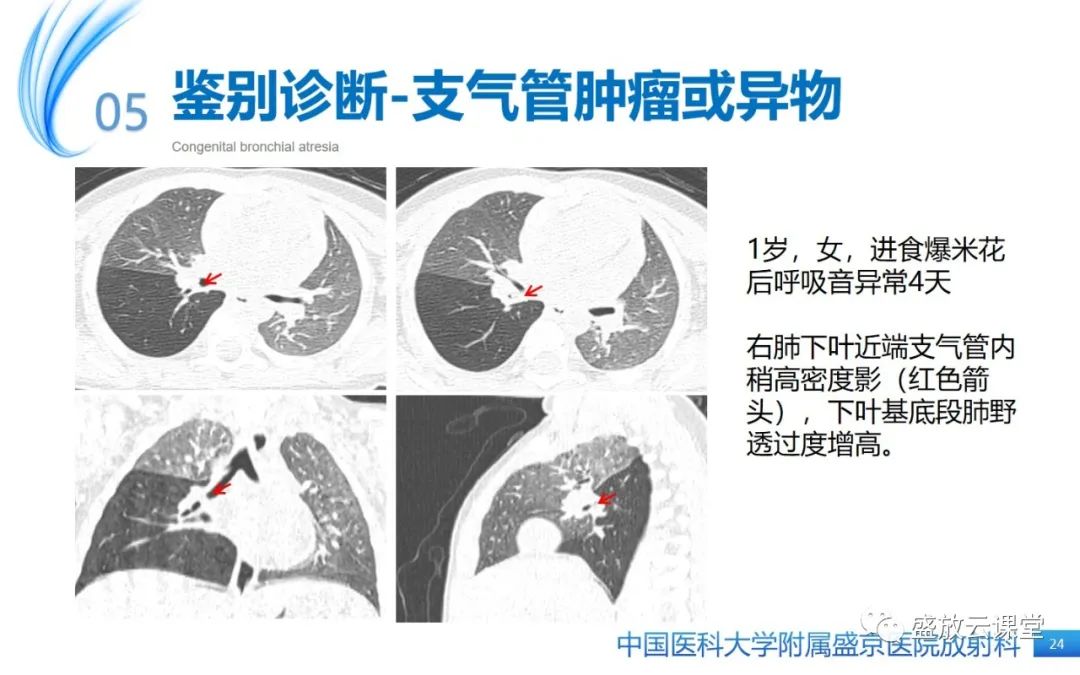 【PPT】先天性支气管闭锁-23