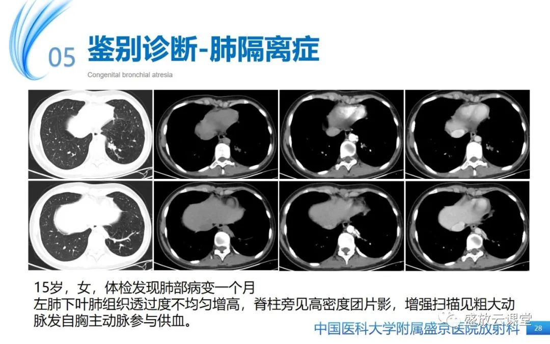 【PPT】先天性支气管闭锁-27
