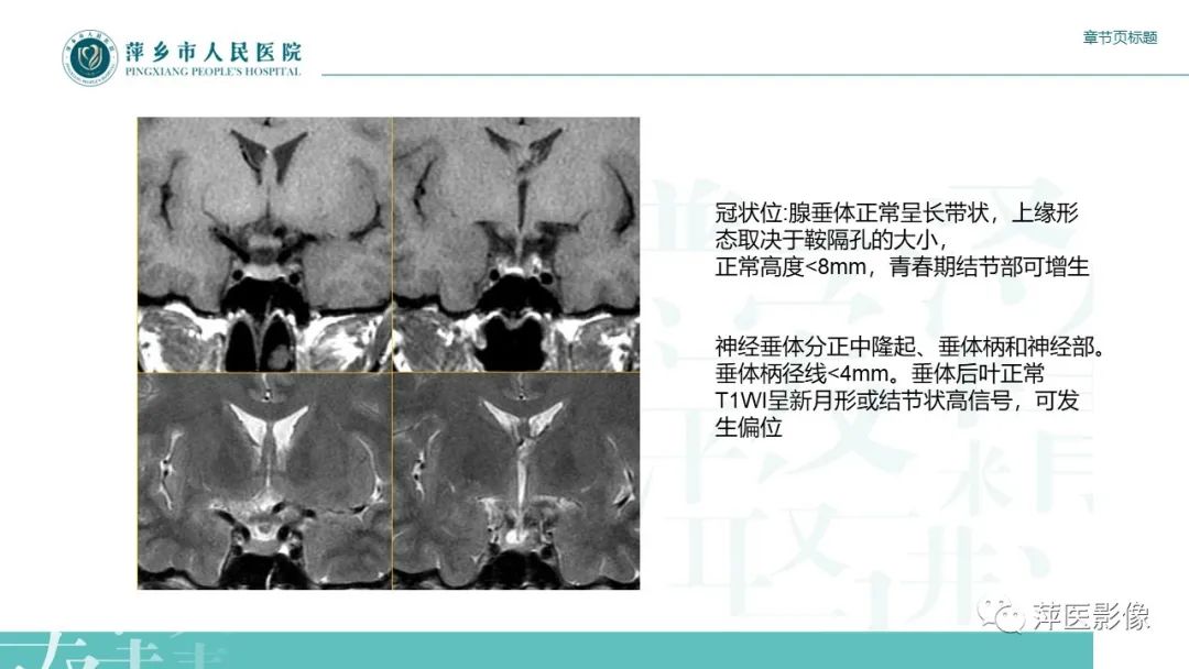 【PPT】垂体常见病变-4