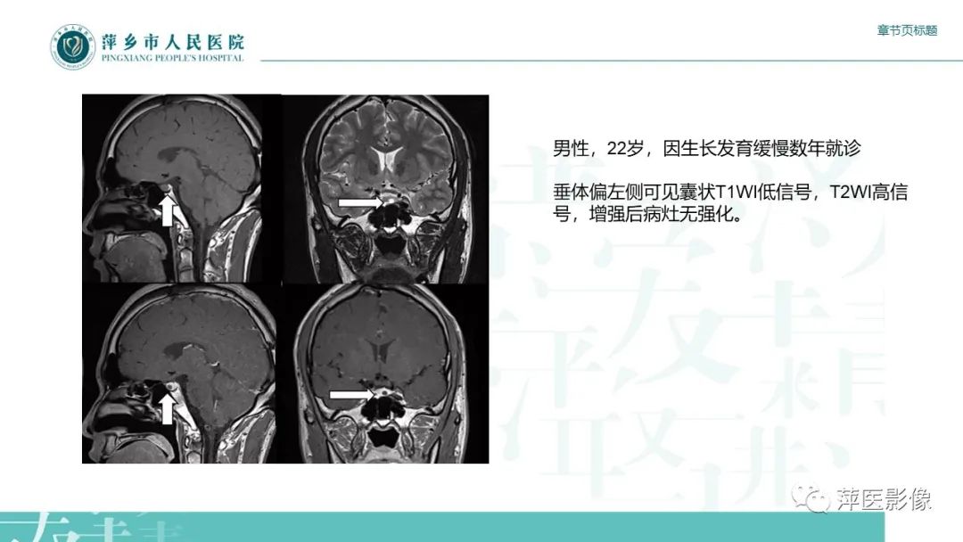 【PPT】垂体常见病变-10