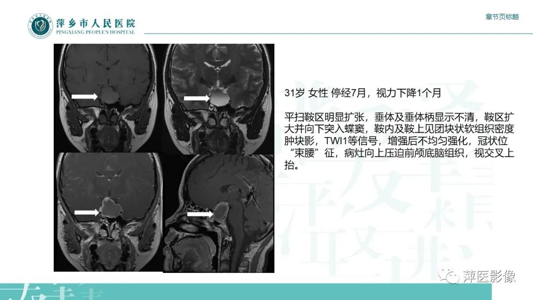 【PPT】垂体常见病变-15