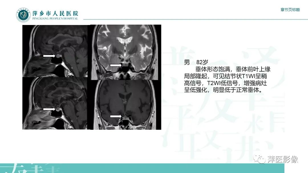 【PPT】垂体常见病变-13