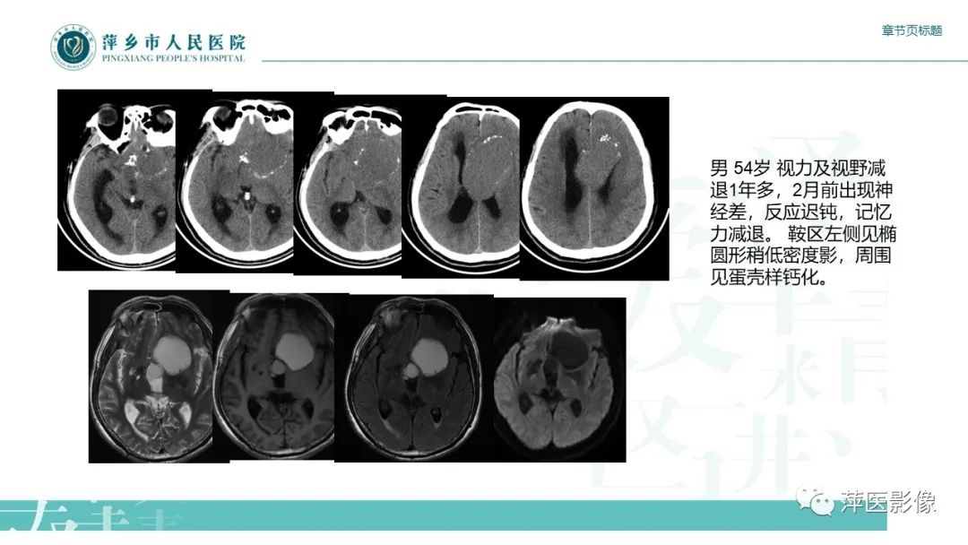 【PPT】垂体常见病变-17