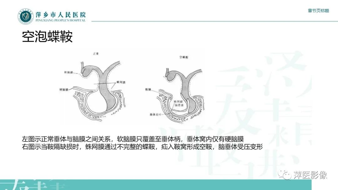 【PPT】垂体常见病变-18