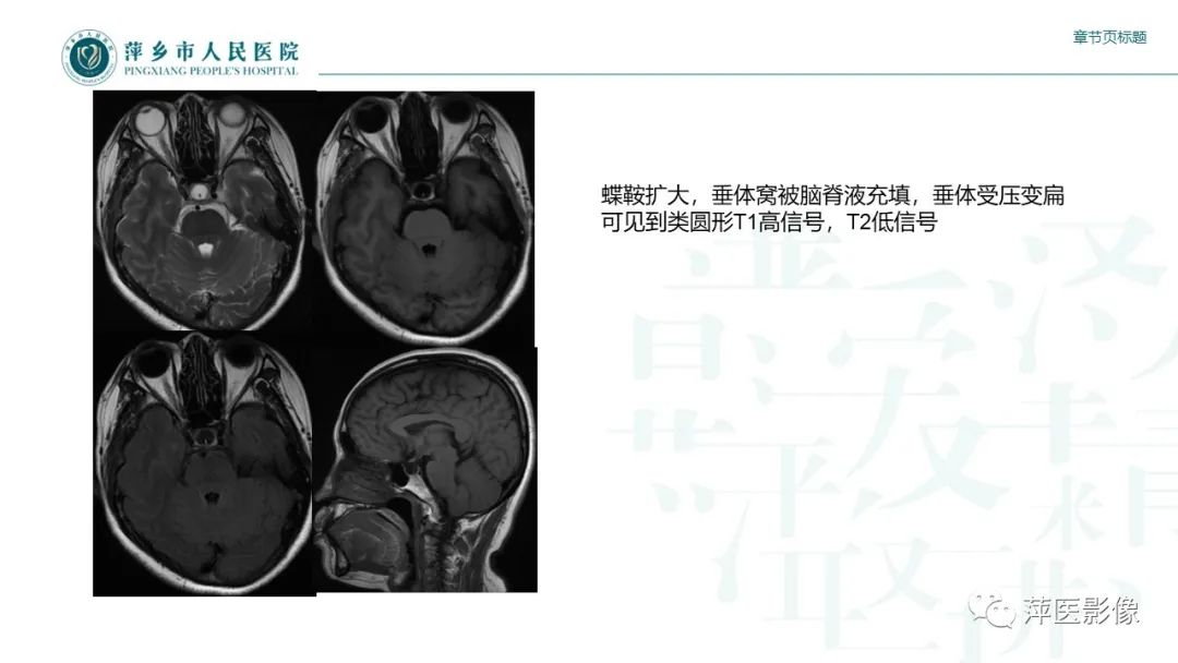 【PPT】垂体常见病变-19