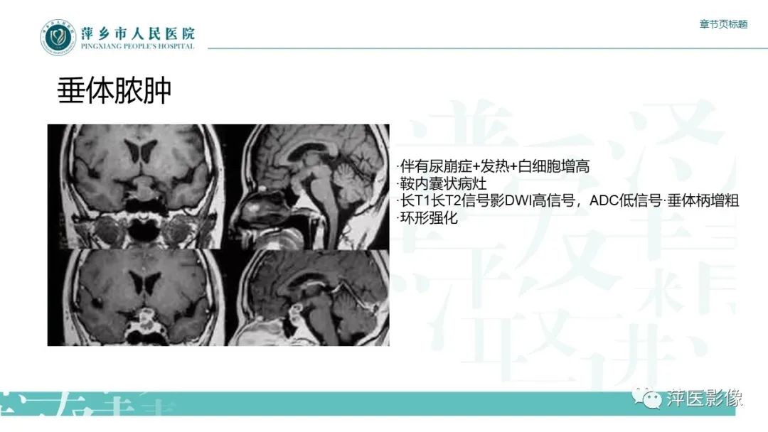 【PPT】垂体常见病变-21