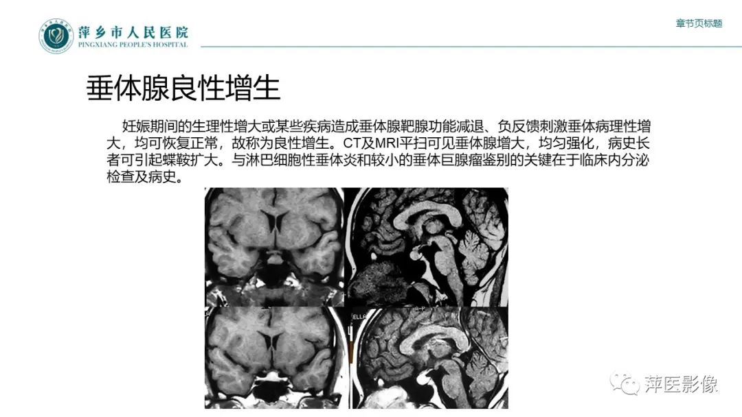 【PPT】垂体常见病变-25