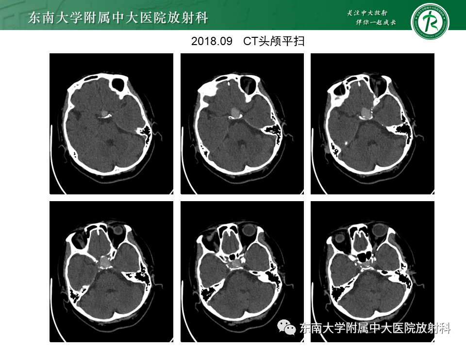 【PPT】成人颅内T1WI高信号病例随访-2