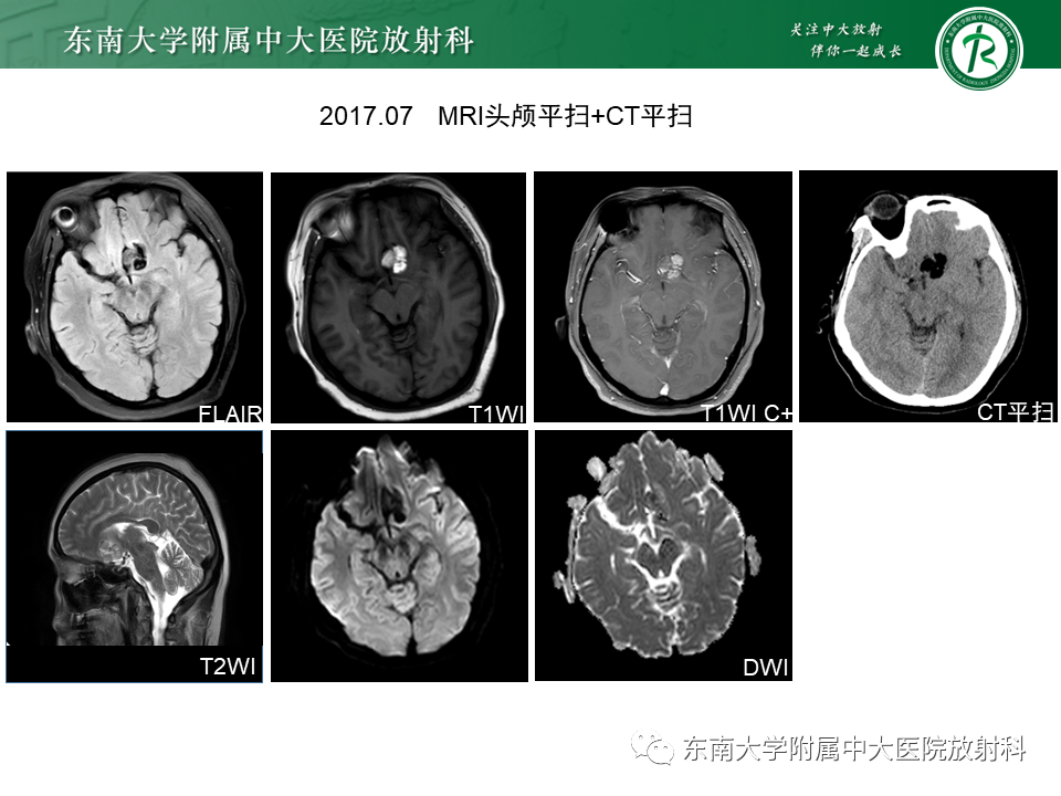 【PPT】成人颅内T1WI高信号病例随访-5