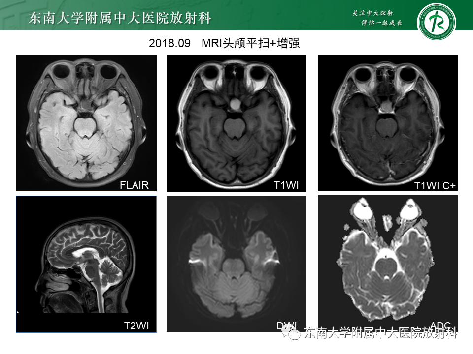 【PPT】成人颅内T1WI高信号病例随访-3