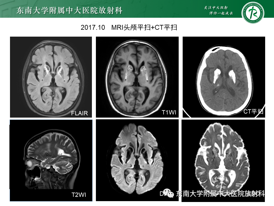 【PPT】成人颅内T1WI高信号病例随访-7