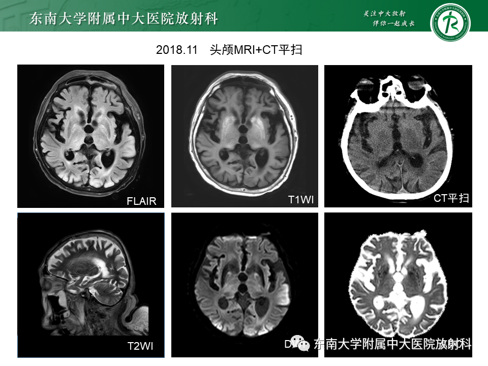 【PPT】成人颅内T1WI高信号病例随访-10