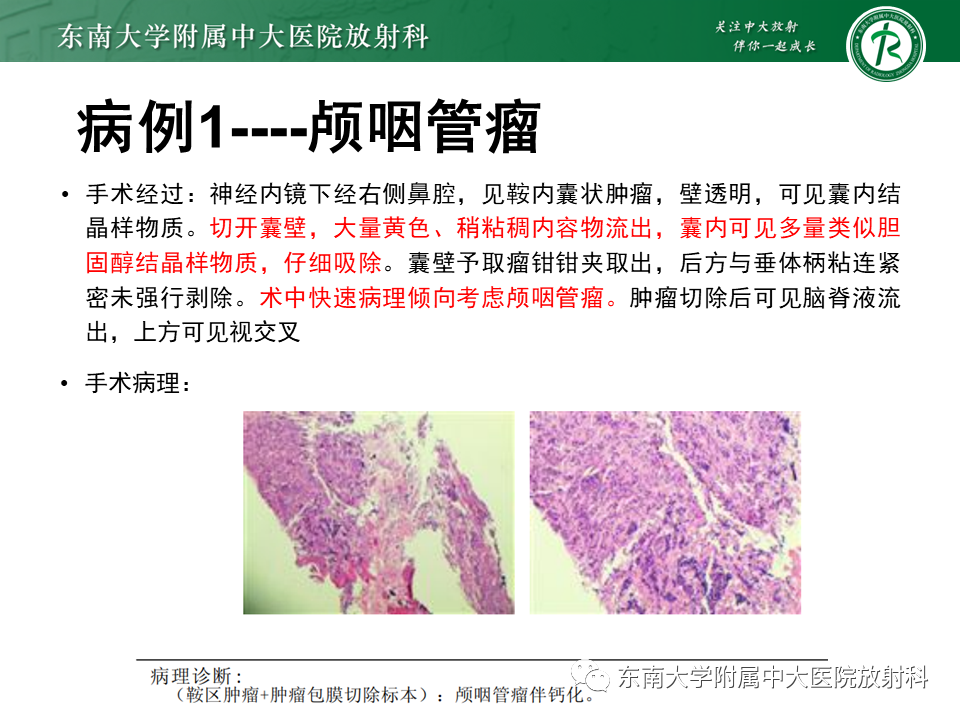 【PPT】成人颅内T1WI高信号病例随访-11