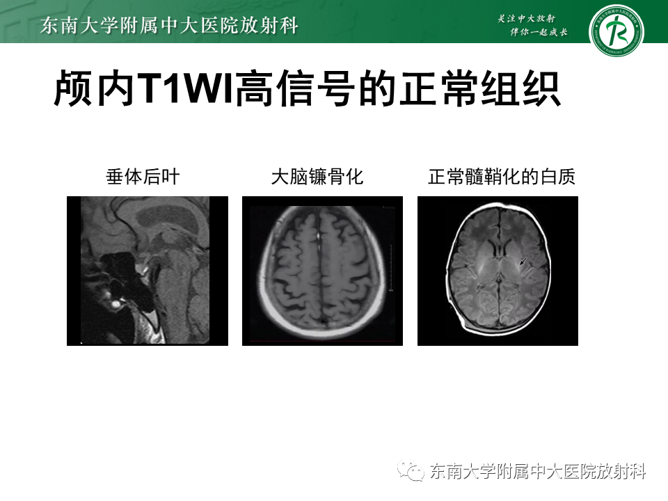 【PPT】成人颅内T1WI高信号病例随访-23