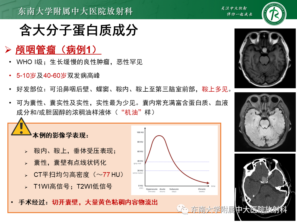 【PPT】成人颅内T1WI高信号病例随访-28