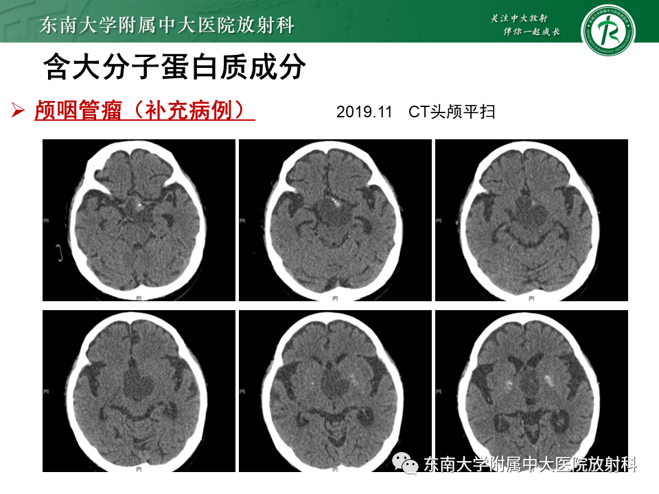 【PPT】成人颅内T1WI高信号病例随访-30