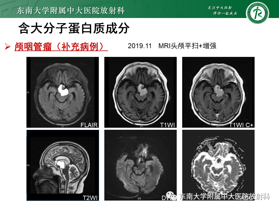 【PPT】成人颅内T1WI高信号病例随访-31