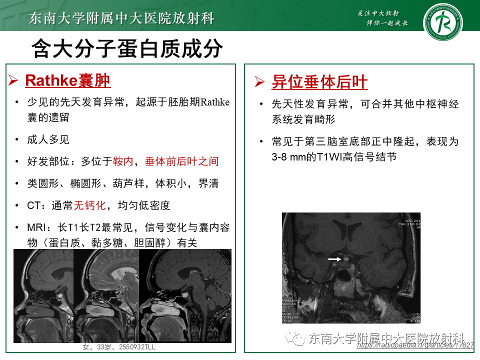 【PPT】成人颅内T1WI高信号病例随访-35