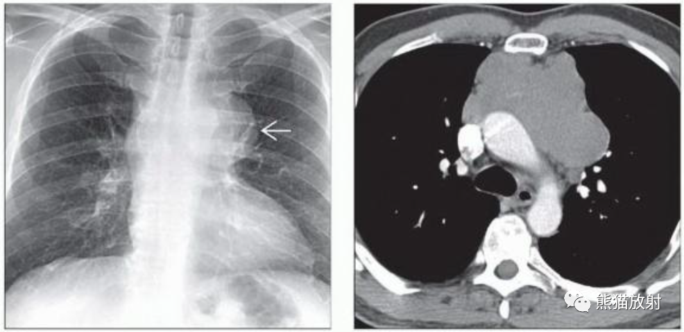 纵隔精原细胞瘤、非精原细胞恶性生殖细胞肿瘤影像表现-1 纵隔精原细胞瘤、非精原细胞恶性生殖细胞肿瘤影像表现-1