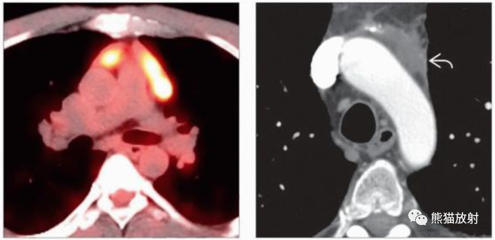 纵隔精原细胞瘤、非精原细胞恶性生殖细胞肿瘤影像表现-2 纵隔精原细胞瘤、非精原细胞恶性生殖细胞肿瘤影像表现-2