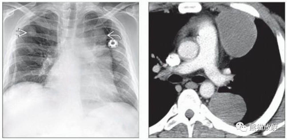 纵隔精原细胞瘤、非精原细胞恶性生殖细胞肿瘤影像表现-3 纵隔精原细胞瘤、非精原细胞恶性生殖细胞肿瘤影像表现-3