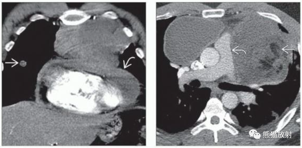 纵隔精原细胞瘤、非精原细胞恶性生殖细胞肿瘤影像表现-4 纵隔精原细胞瘤、非精原细胞恶性生殖细胞肿瘤影像表现-4